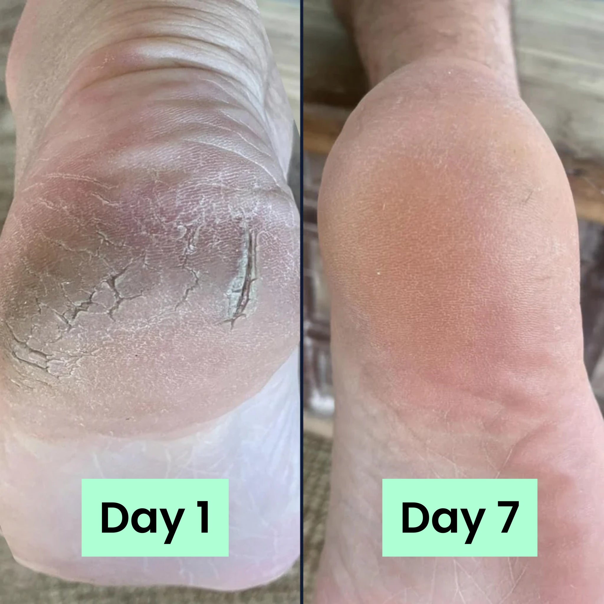 HeelRelief® Repair Bar