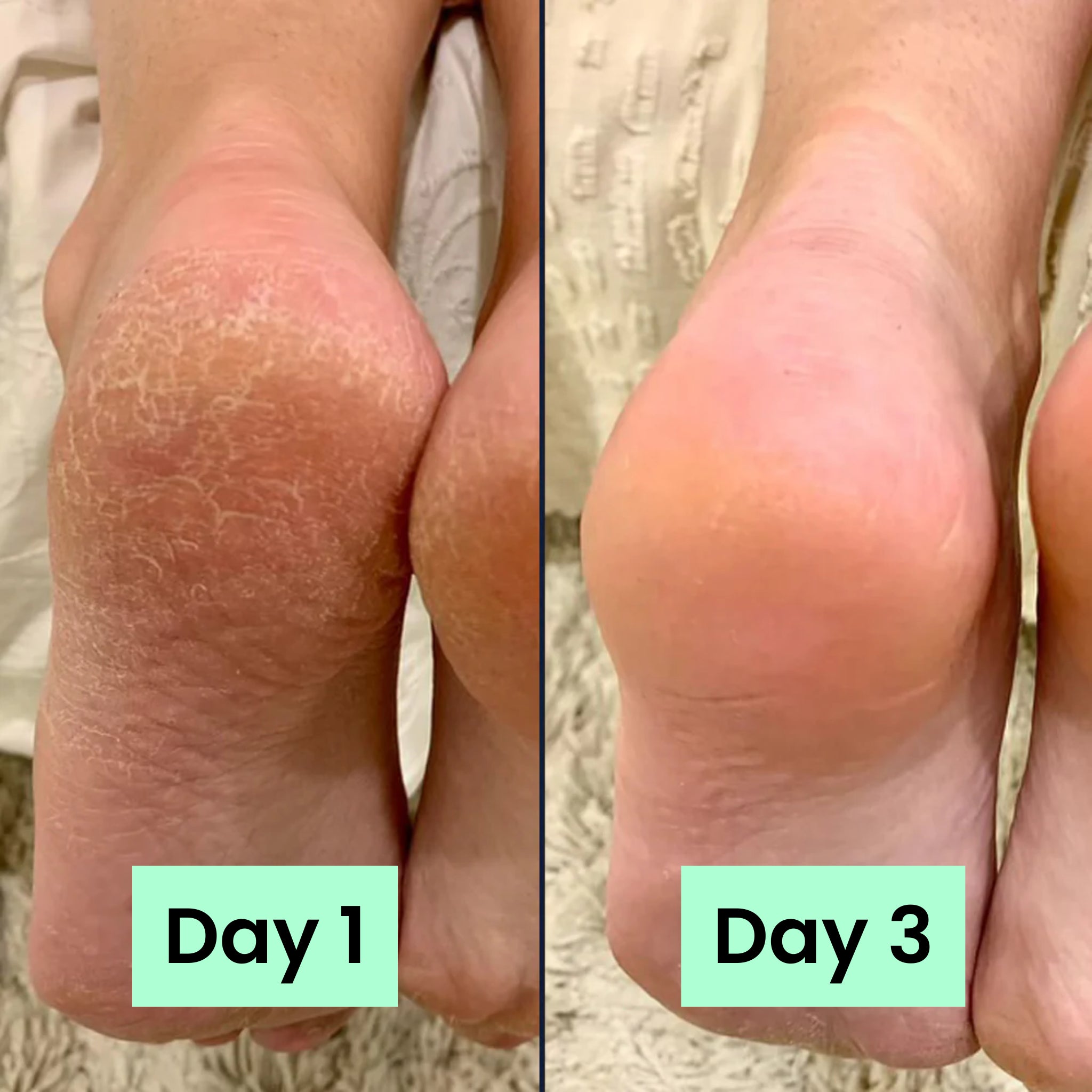 HeelRelief® Repair Bar