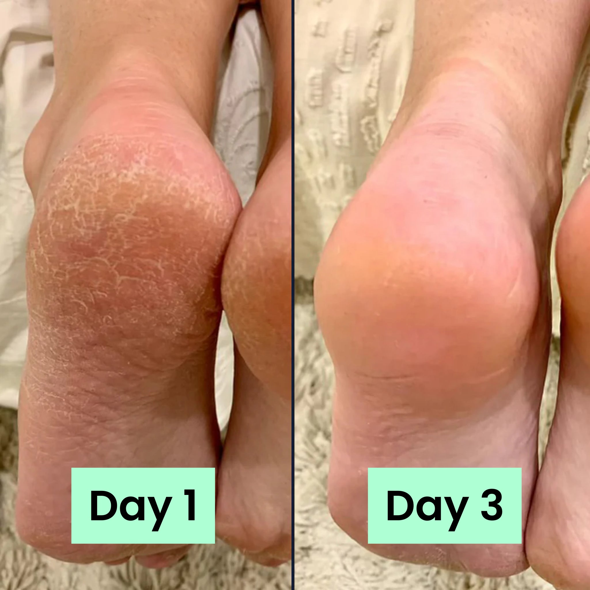 HeelRelief® Repair Bar