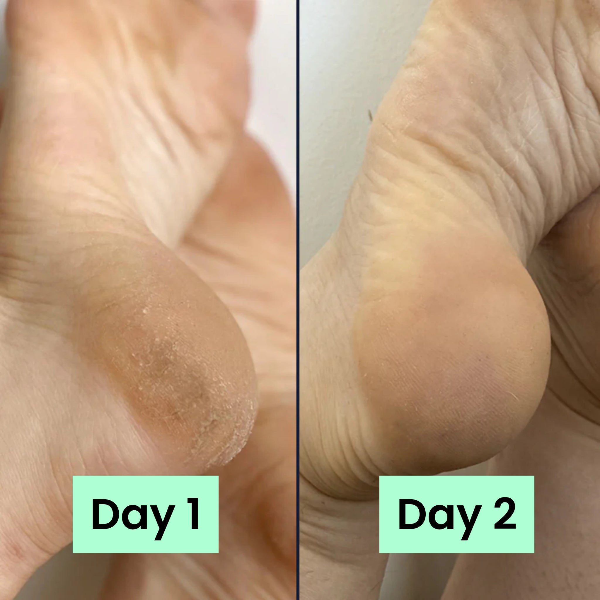 HeelRelief® Repair Bar