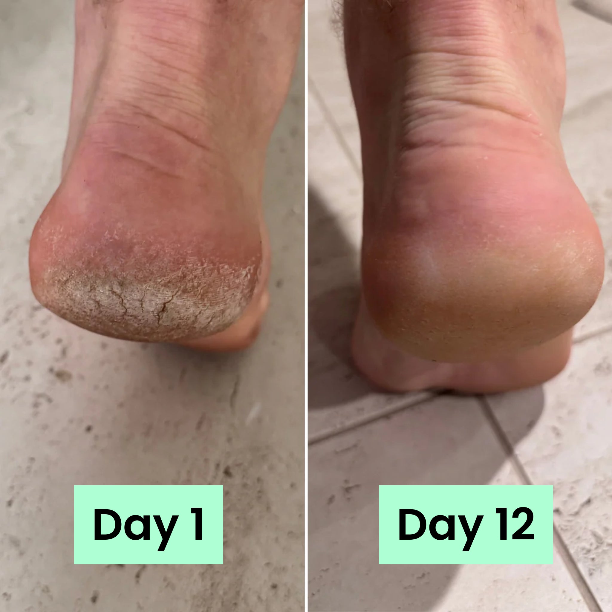 HeelRelief® Repair Bar