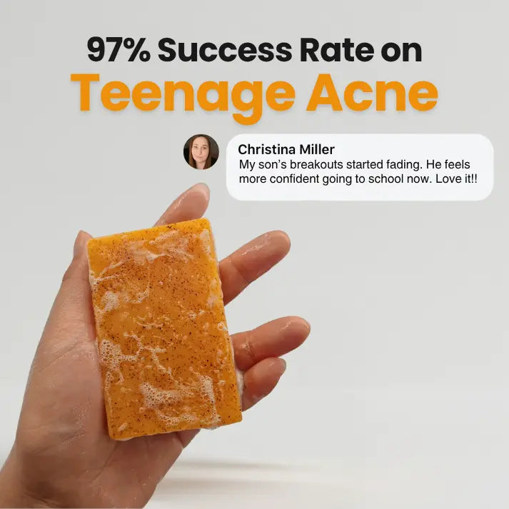 Clear Teen Acne & Redness Bar