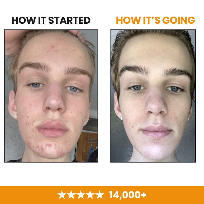 Clear Teen Acne & Redness Bar