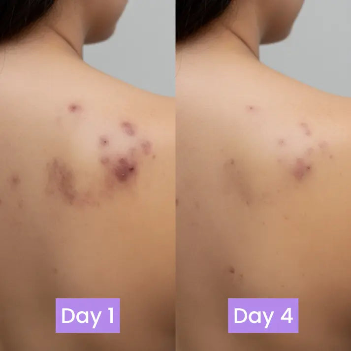 Back Acne & Scar Treatment Bar